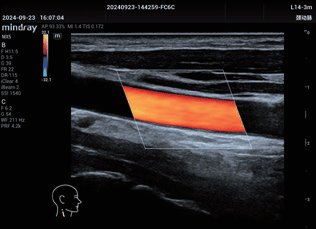 carotida-2 Imagen clínica con ecógrafo del hígado